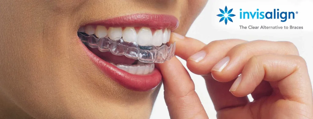 Ortodonzia Invisalign a Torino